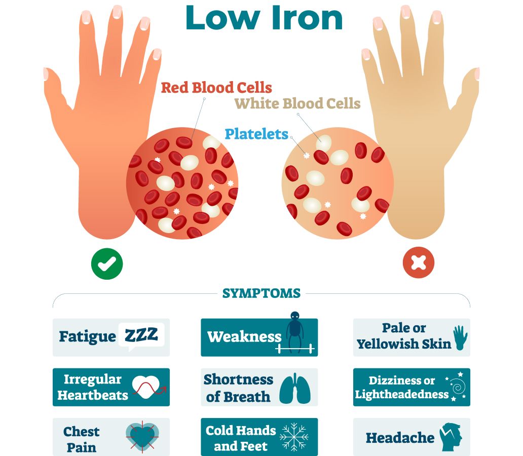 Low iron symptoms